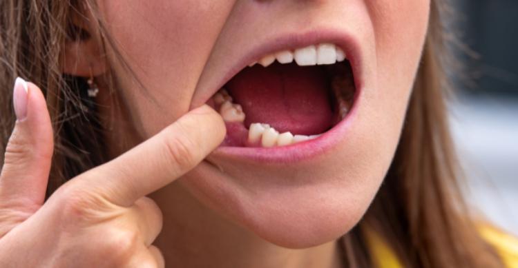 nằm mơ bị rụng răng hàm dưới